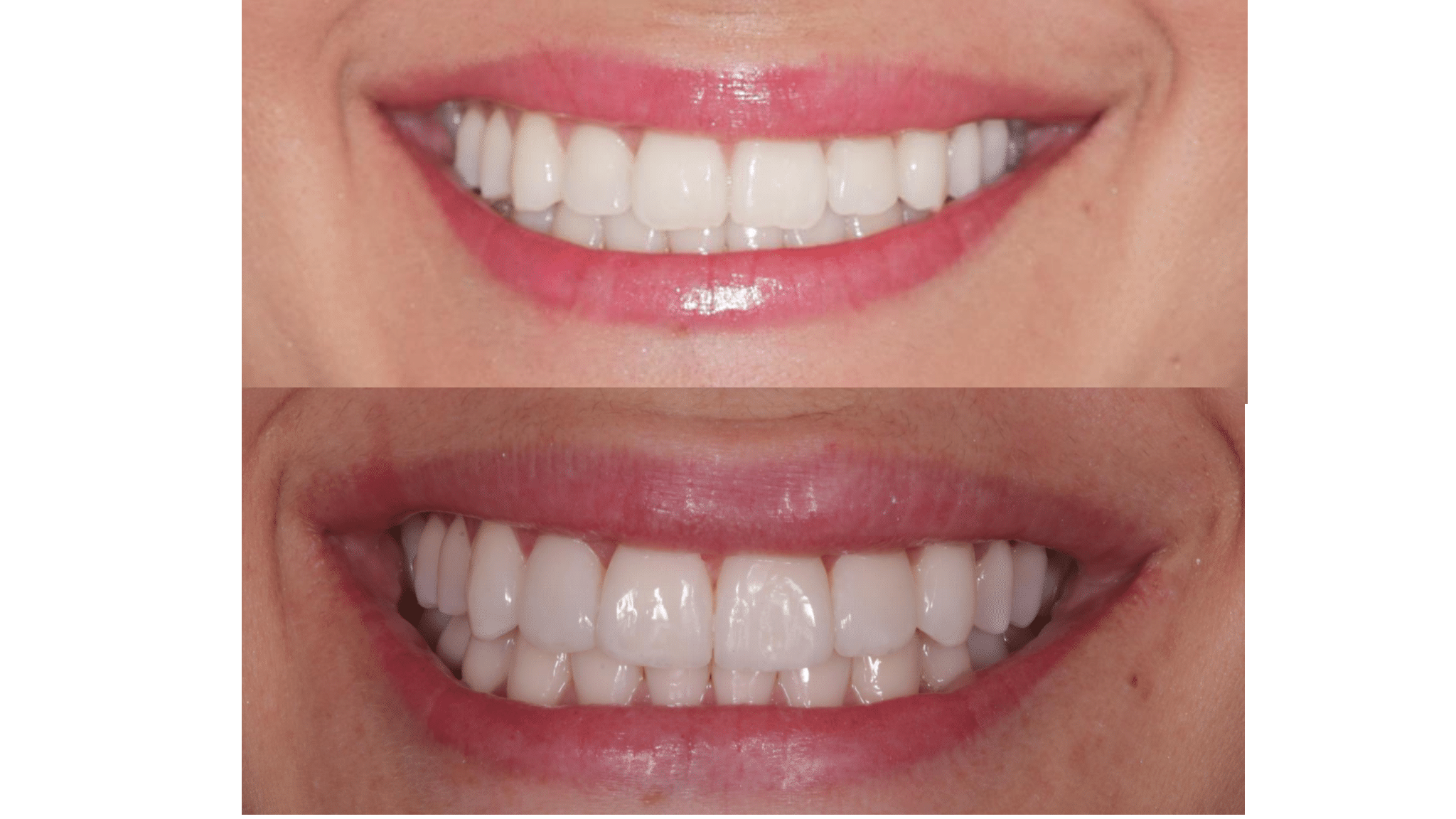 Dra.-Fernanda-Baboni-Lentes-de-Contato-Dental-Facetas-em-Curitiba-02.png