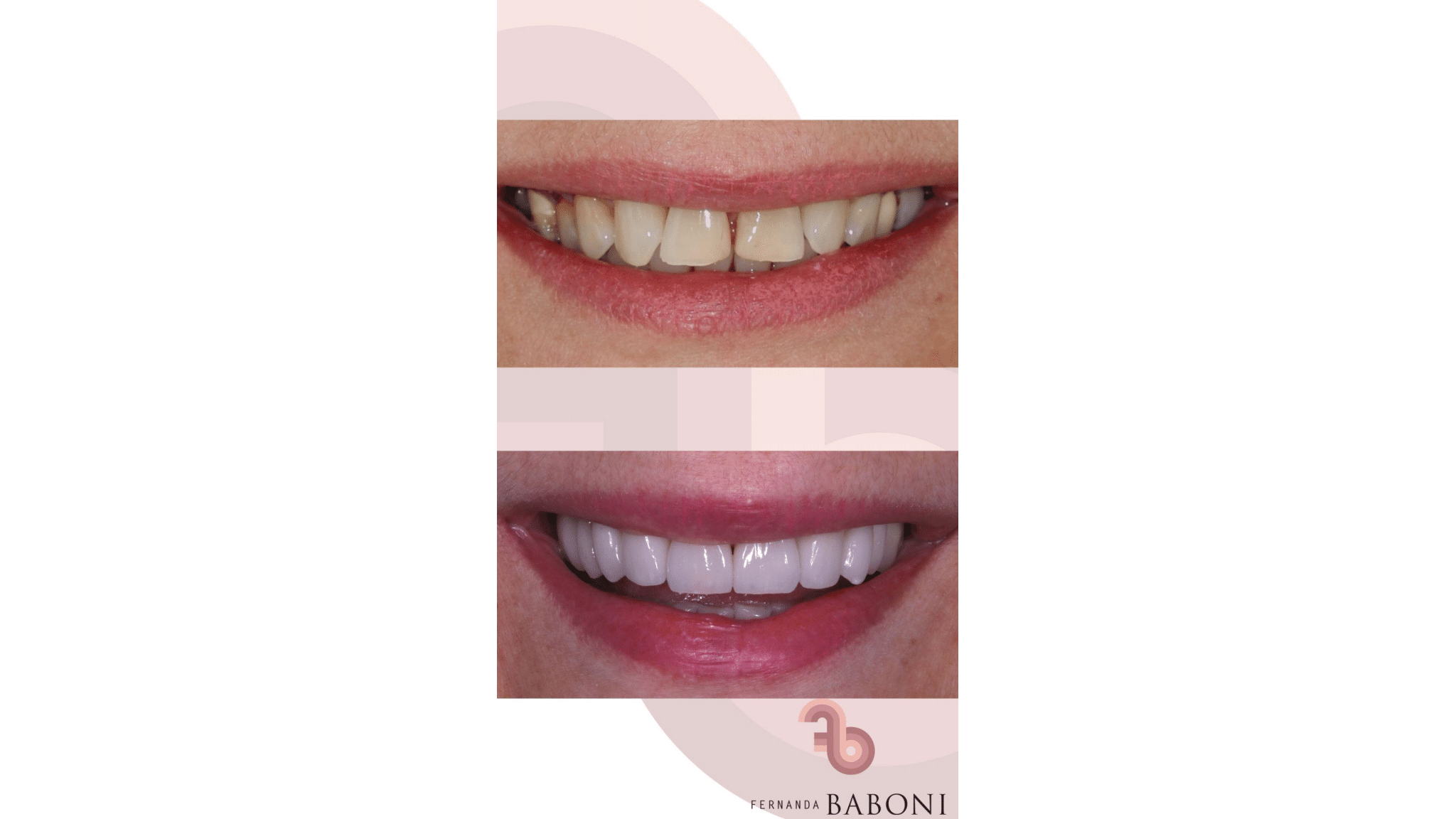 Dra.-Fernanda-Baboni-Lentes-de-Contato-Dental-Facetas-em-Curitiba-03.png