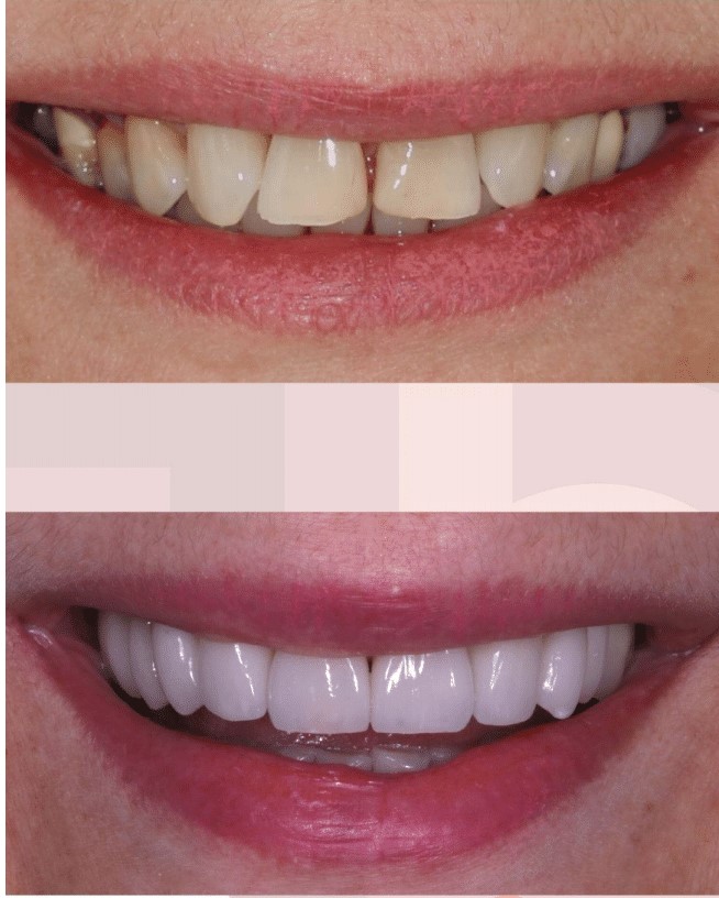Dra.-Fernanda-Baboni-Lentes-de-Contato-Dental-Facetas-em-Curitiba-04.jpg