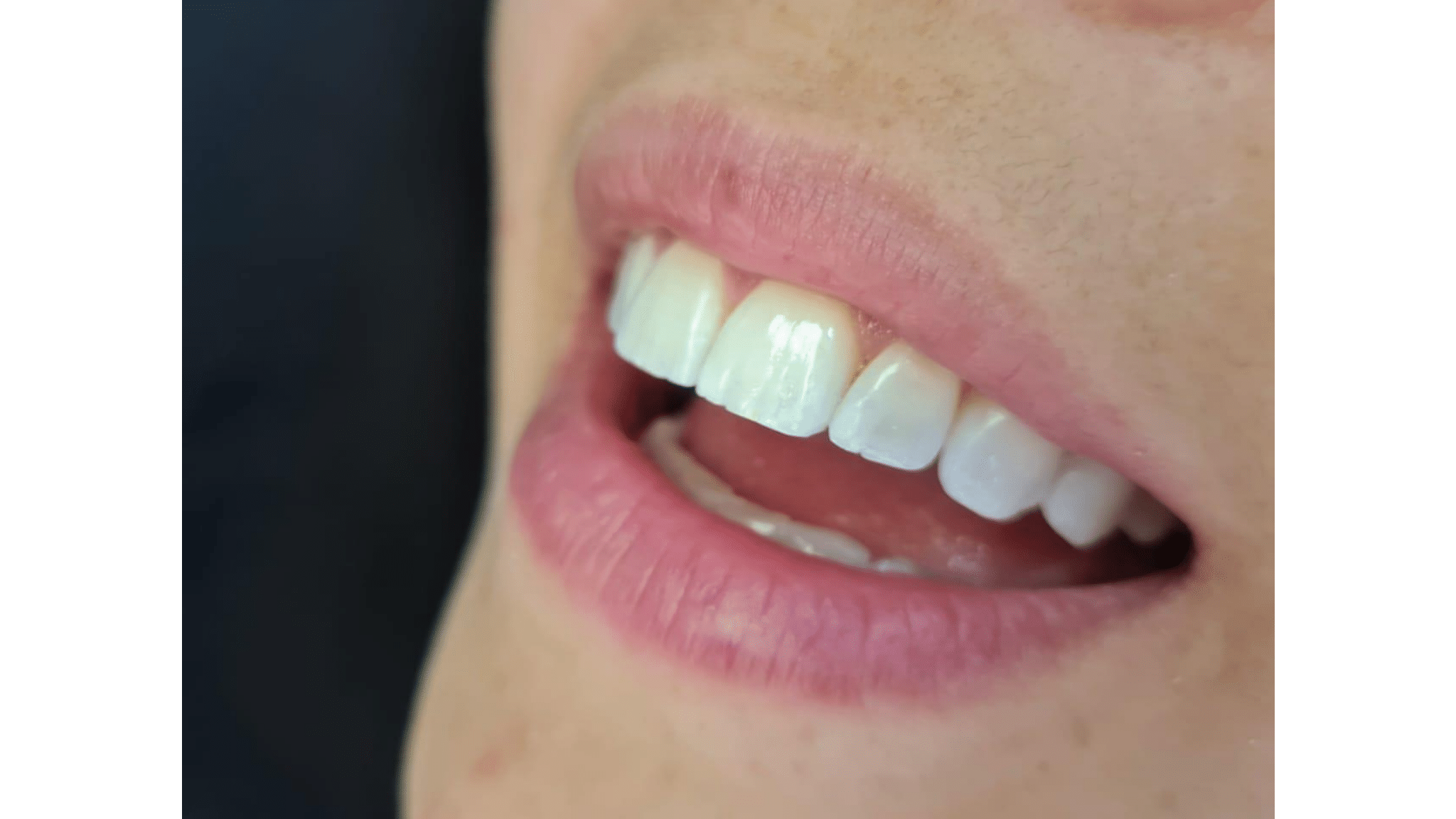 Dra.-Fernanda-Baboni-Lentes-de-Contato-Dental-Facetas-em-Curitiba-05.png