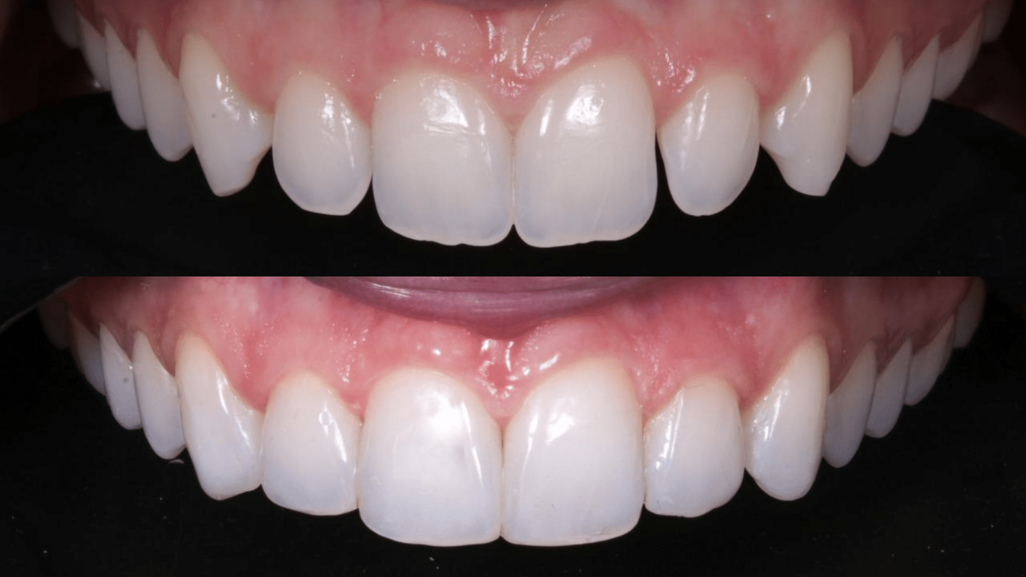 Dra.-Fernanda-Baboni-Lentes-de-Contato-Dental-Facetas-em-Curitiba-06.png