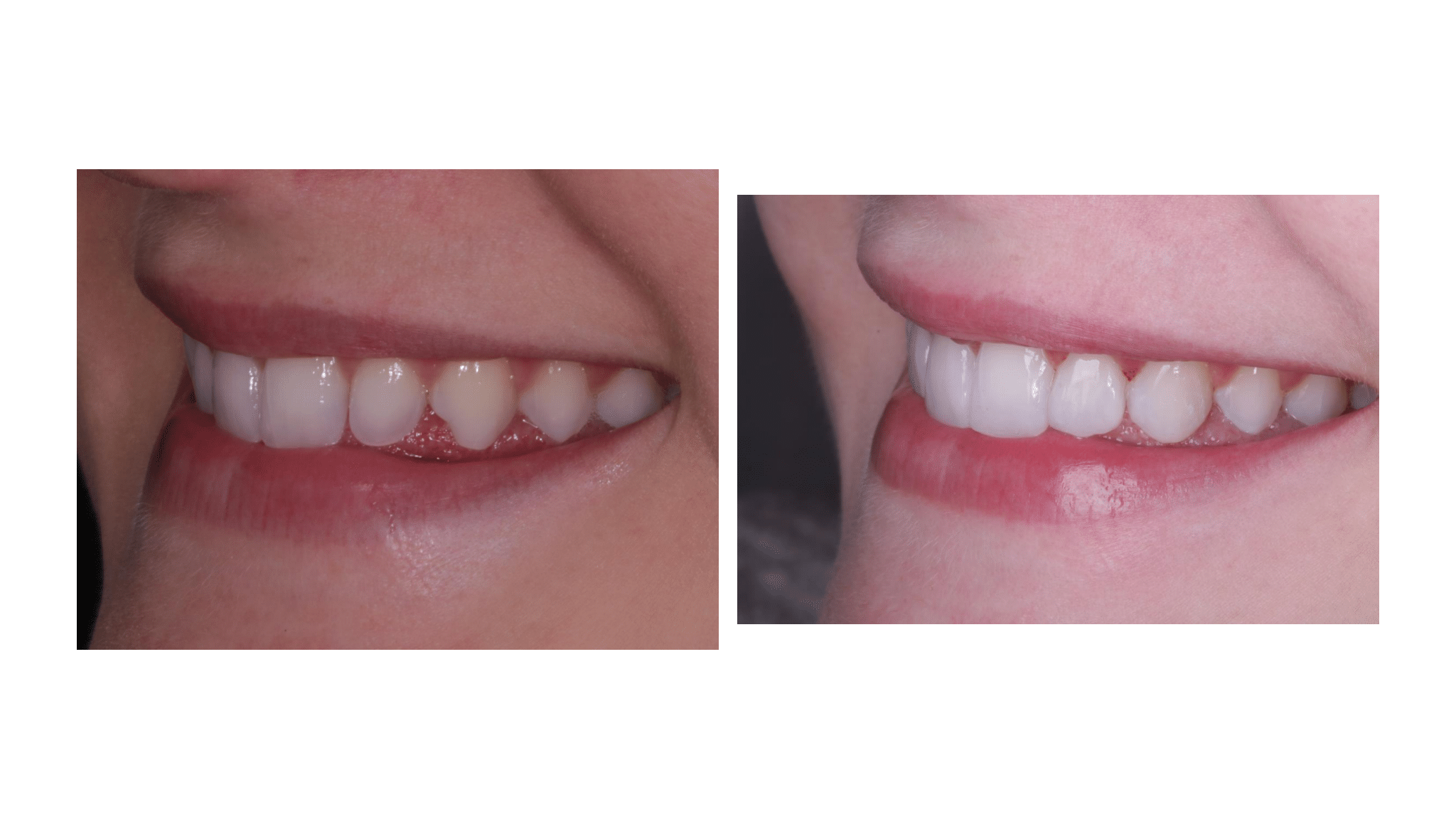 Dra.-Fernanda-Baboni-Lentes-de-Contato-Dental-Facetas-em-Curitiba-07.png