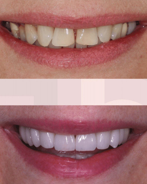 Dra.-Fernanda-Baboni-Lentes-de-Contato-Dental-Facetas-em-Curitiba-08.png