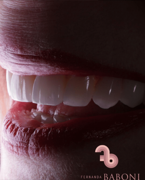Dra.-Fernanda-Baboni-Lentes-de-Contato-Dental-Facetas-em-Curitiba-09.png