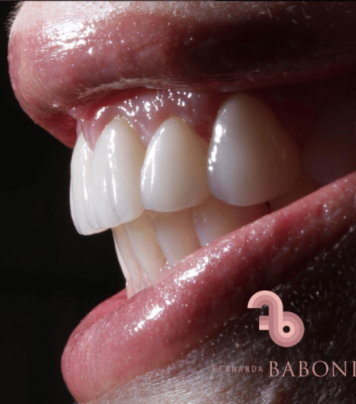 Dra.-Fernanda-Baboni-Lentes-de-Contato-Dental-Facetas-em-Curitiba-10.png